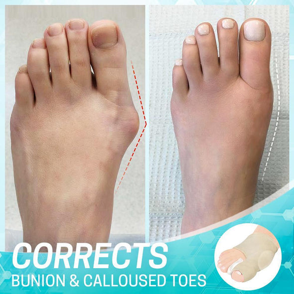 Dr.Huta | Bunion Correction Sleeve | 1+1 Gratis (2 paar)