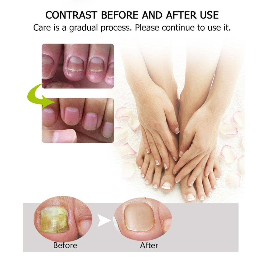 NailFix™ Snel en effectief resultaat!