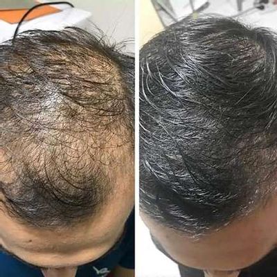 ReGrow™ | Herleef je haar