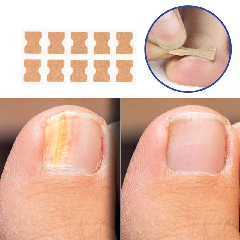 EasyPlaster™ | Corrigerende pleisters voor mooie en gezonde nagels | 25 + 25 Gratis