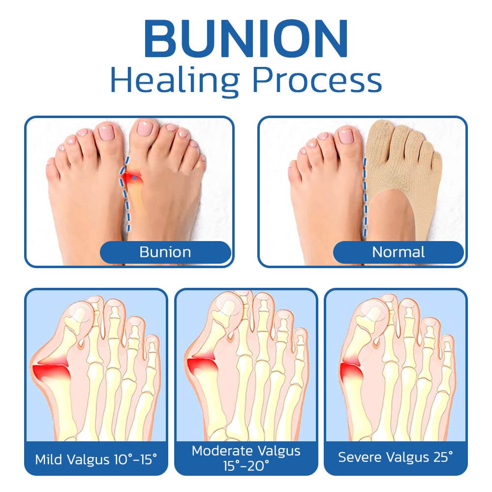 Projoint | AntiBunions gezondheidssok