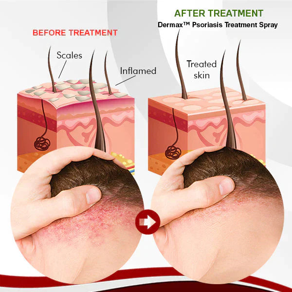 DermaTec | Psoriasis Behandel Spray | 1+1 GRATIS